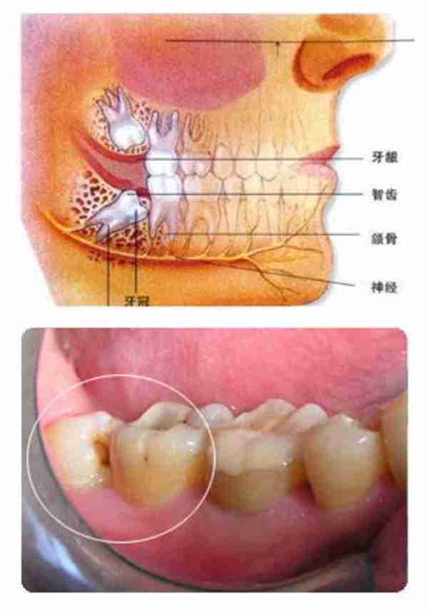 牙齿萌出困难称为"阻生齿"或"埋伏牙".