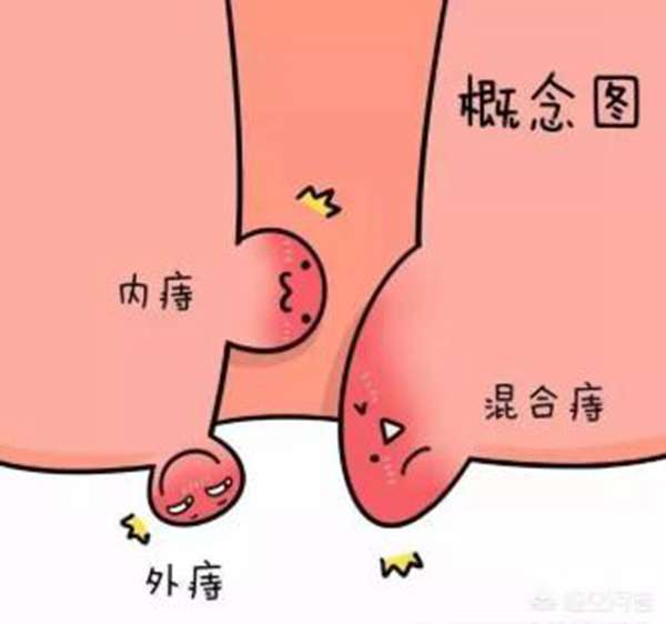怎么预防痔疮（为什么会得痔疮，您知道吗）