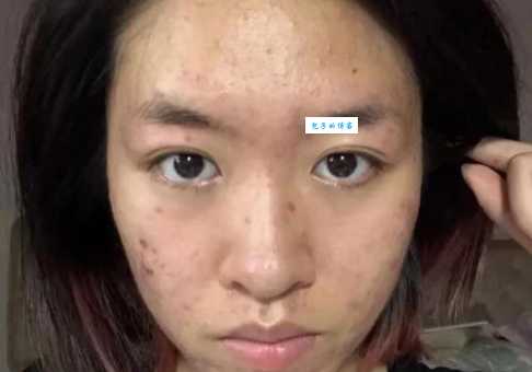 珍珠粉可以去痘印吗？亲测有效，痘印真的消失了！